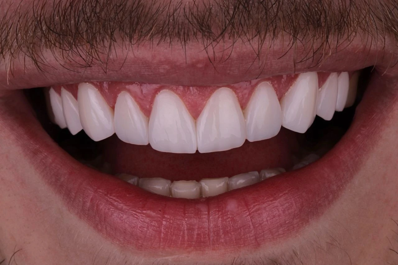 Sorriso depois do tratamento